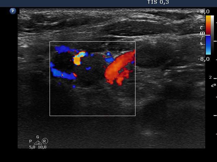 Right lobe, longitudinal scan