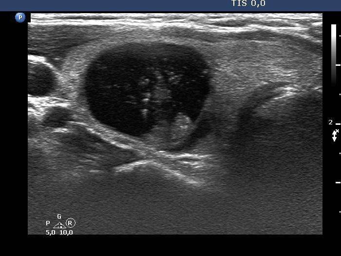Right lobe, longitudinal scan