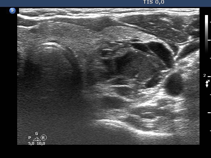 Right lobe, longitudinal scan