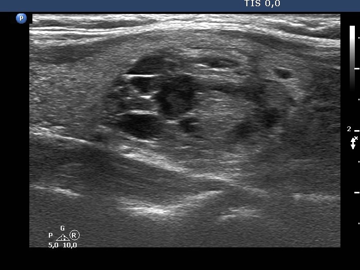 Right lobe, longitudinal scan