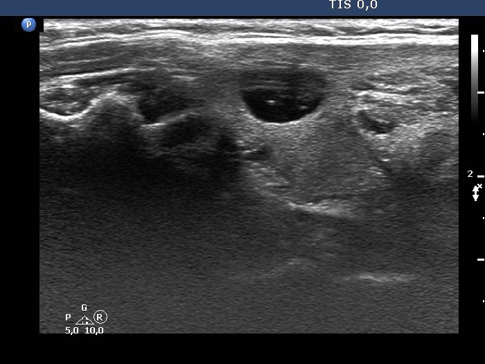 Right lobe, longitudinal scan