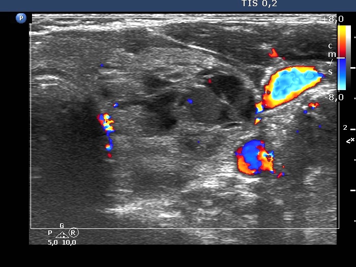 Right lobe, longitudinal scan