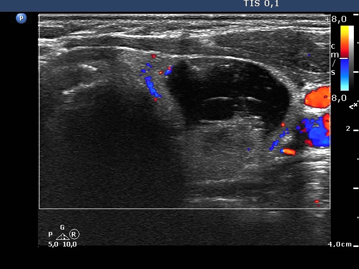 Right lobe, longitudinal scan