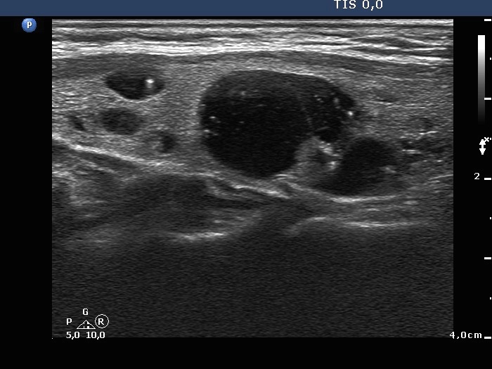 Right lobe, longitudinal scan