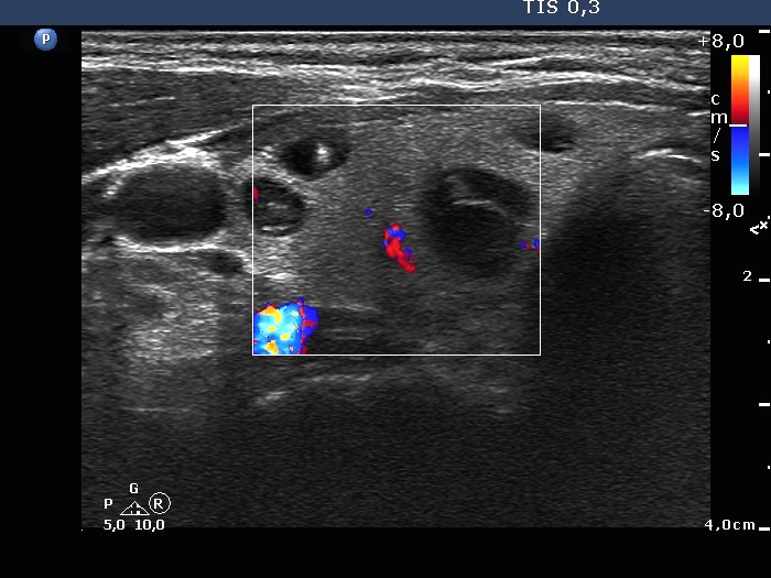 Right lobe, longitudinal scan
