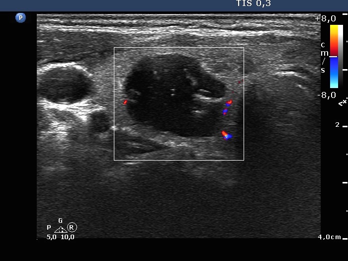 Right lobe, longitudinal scan