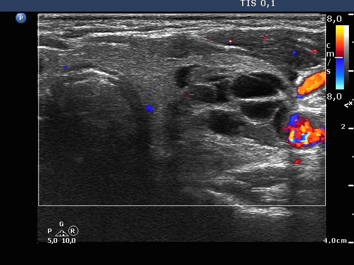 Right lobe, longitudinal scan