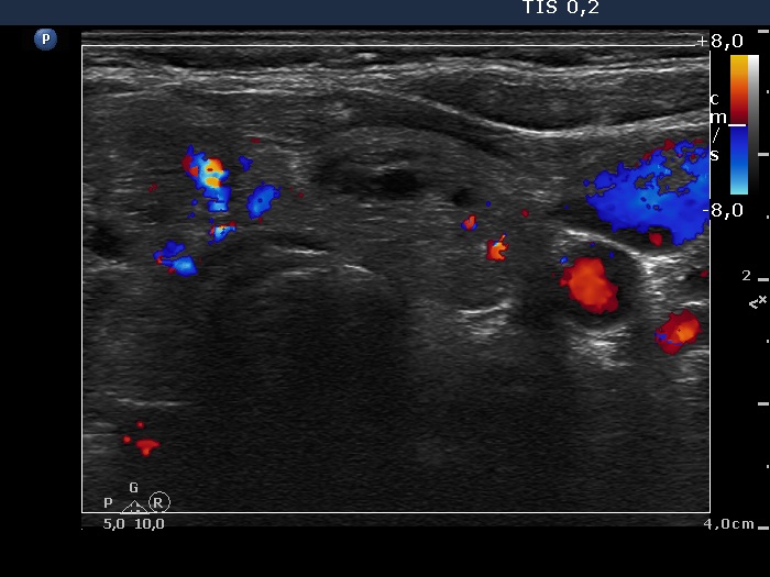 Right lobe, longitudinal scan