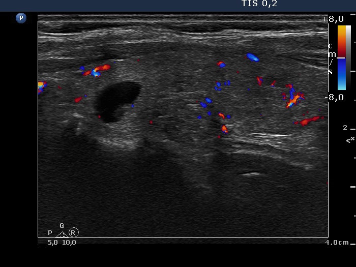 Right lobe, longitudinal scan