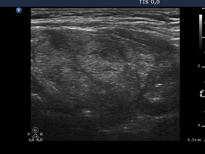 Right lobe, longitudinal scan
