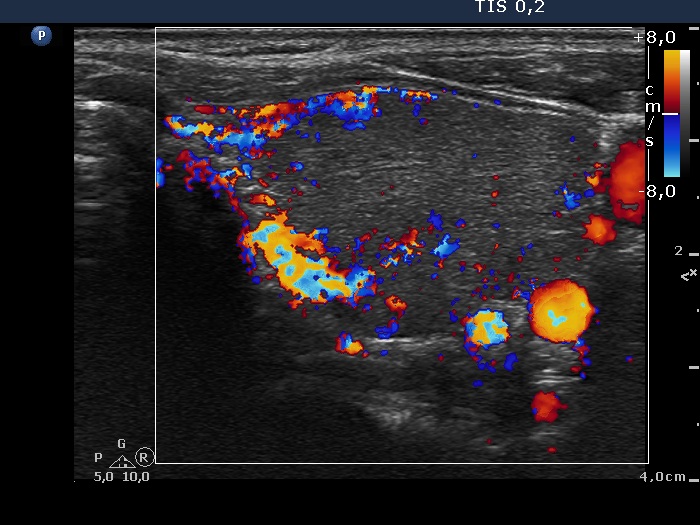 Right lobe, longitudinal scan