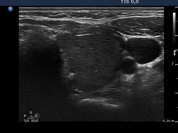 Right lobe, longitudinal scan