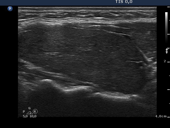 Right lobe, longitudinal scan