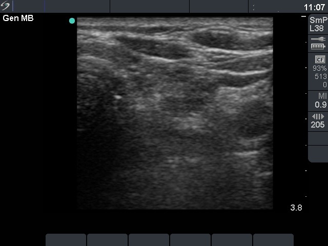 Right lobe, longitudinal scan