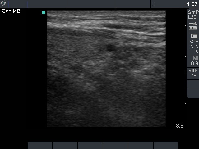 Right lobe, longitudinal scan