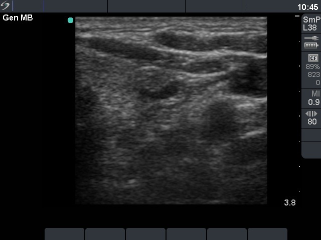 Right lobe, longitudinal scan