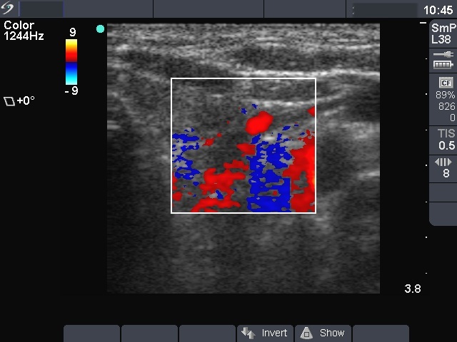 Right lobe, longitudinal scan