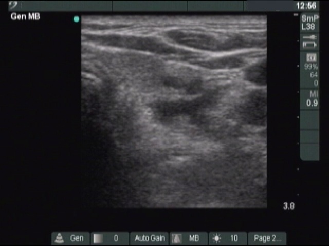 Right lobe, horizontal view