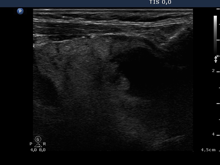 Right lobe, longitudinal scan