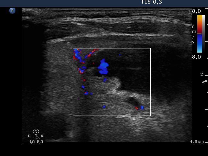 Right lobe, longitudinal scan