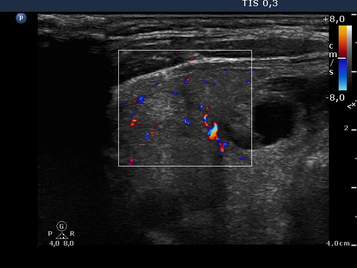 Right lobe, longitudinal scan
