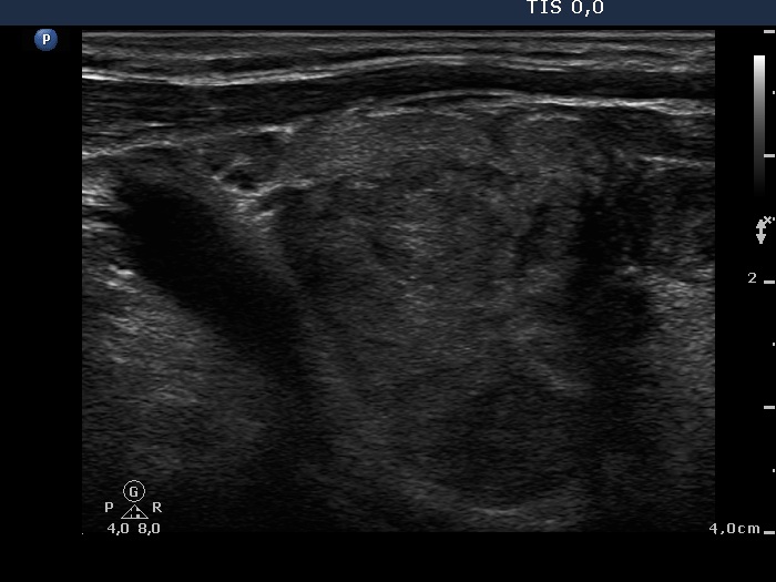 Right lobe, longitudinal scan