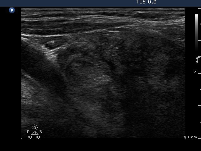 Right lobe, longitudinal scan