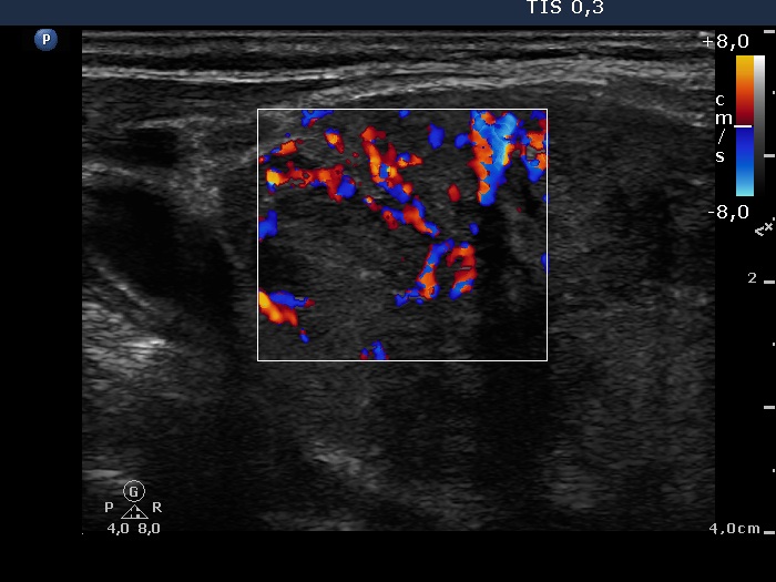 Right lobe, longitudinal scan
