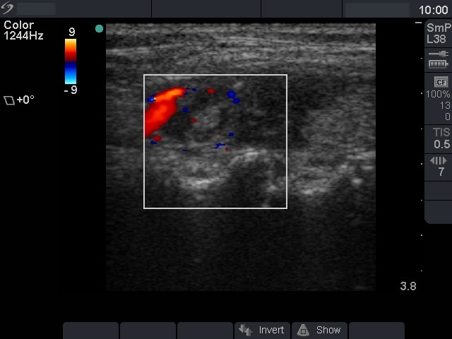 Right lobe, longitudinal scan