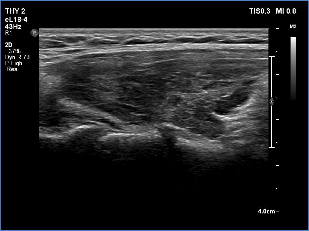 Right lobe, longitudinal scan