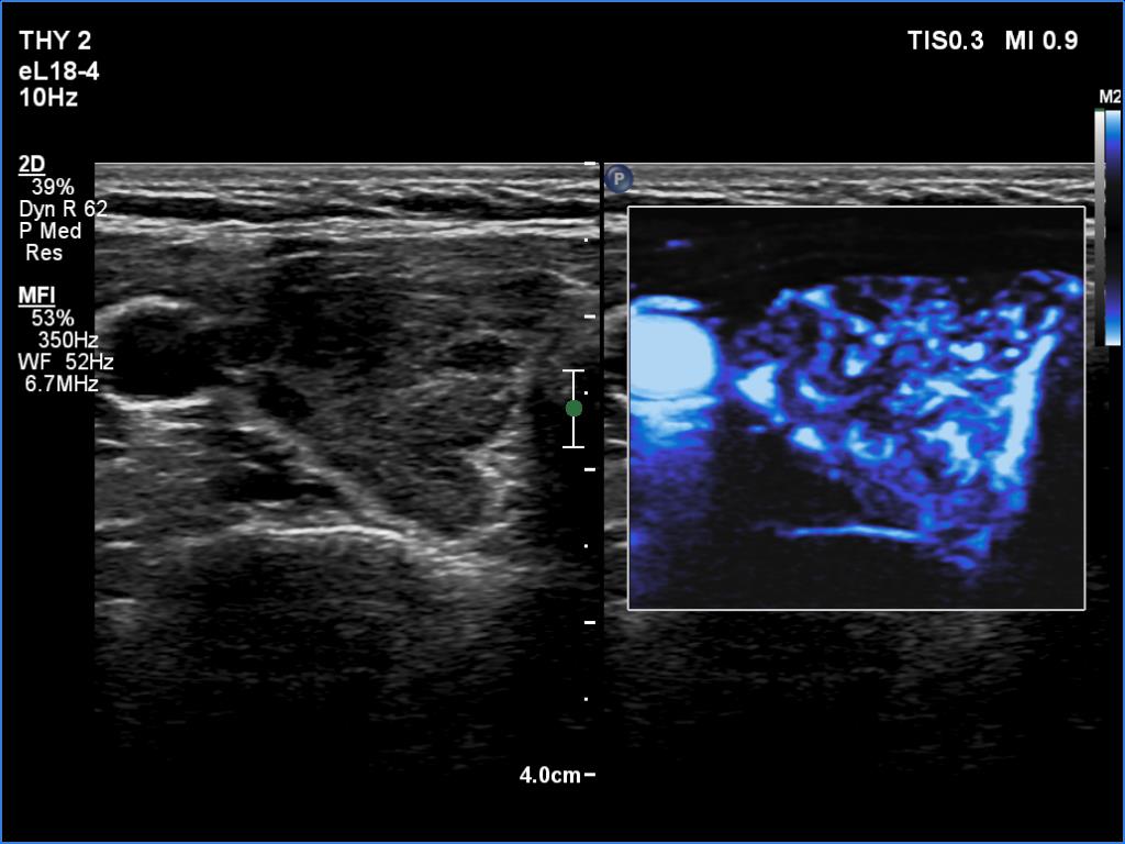 Right lobe, longitudinal scan