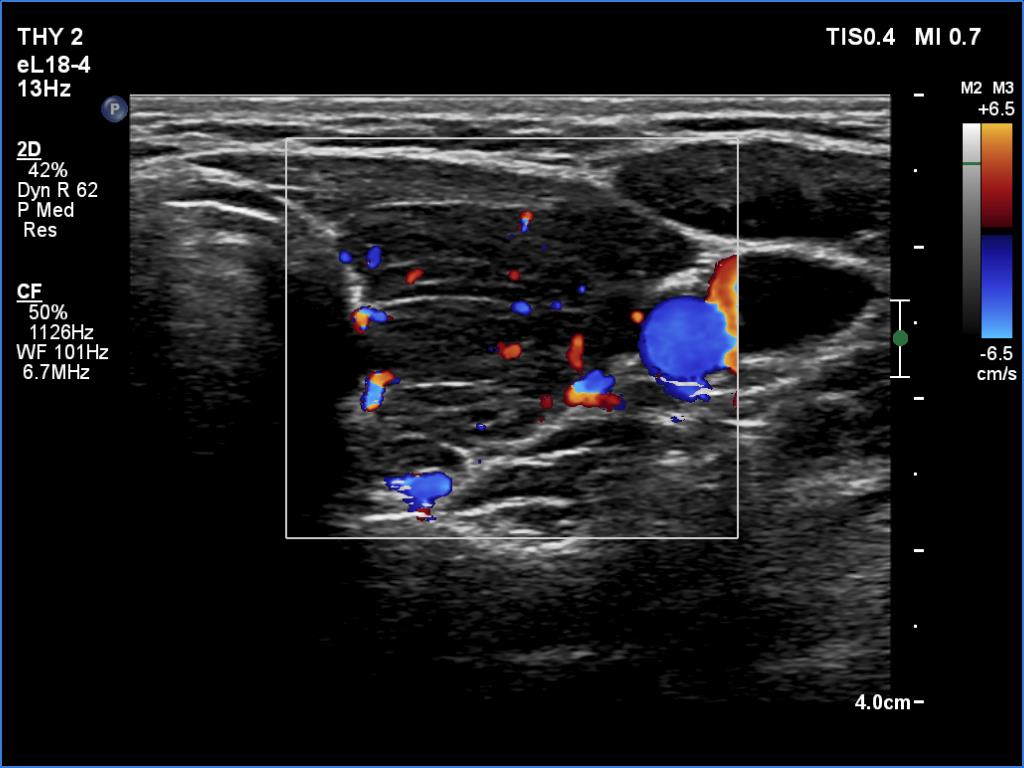 Right lobe, longitudinal scan