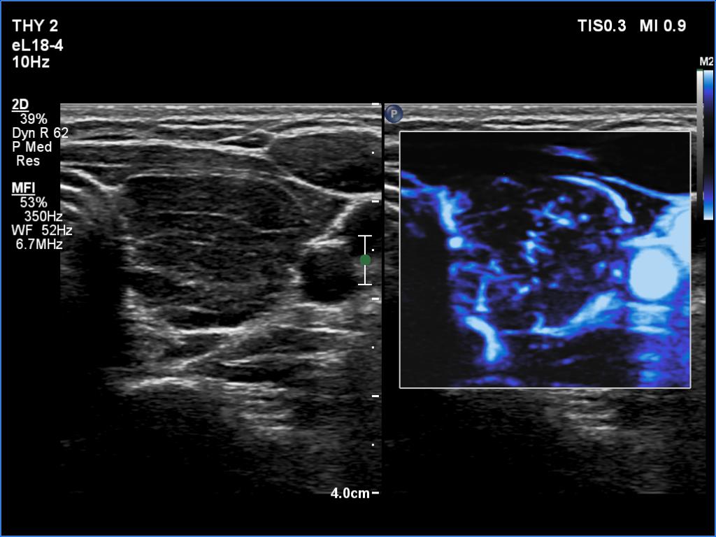 Right lobe, longitudinal scan