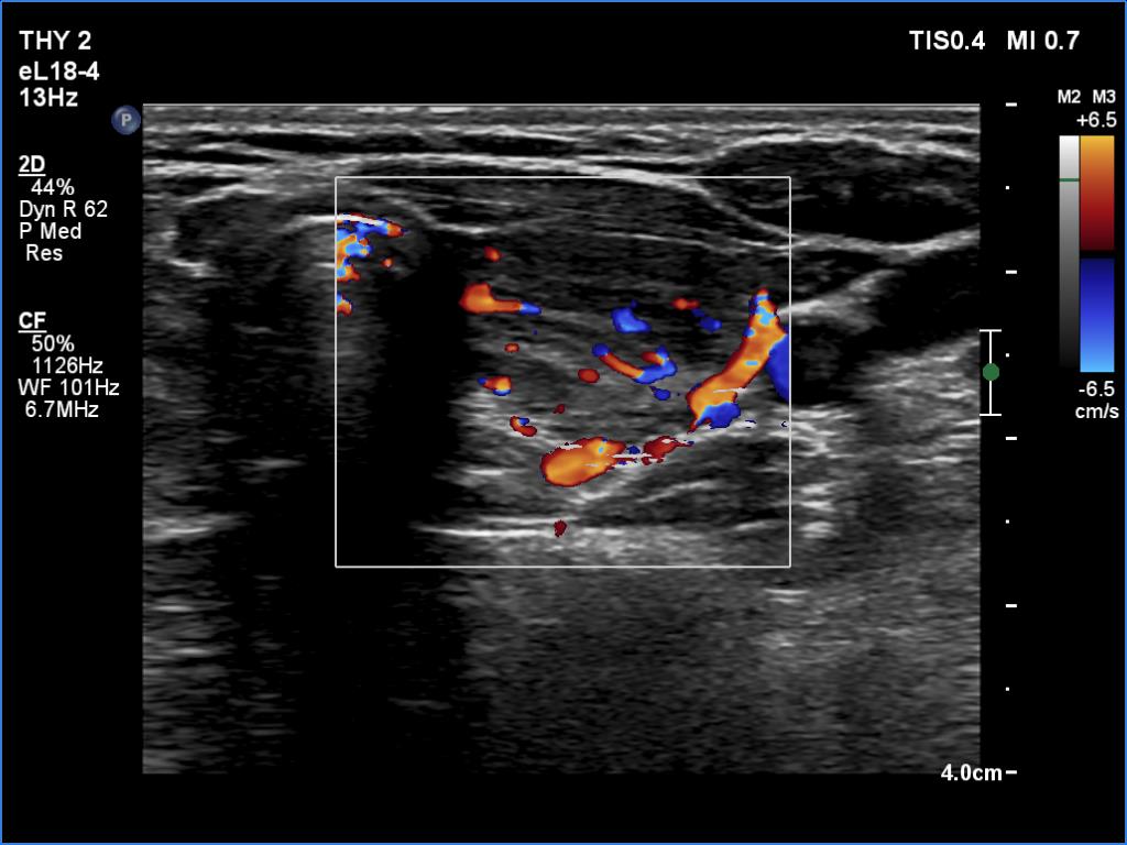 Right lobe, longitudinal scan