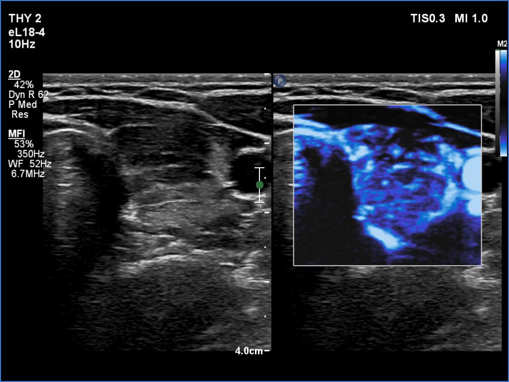 Right lobe, longitudinal scan