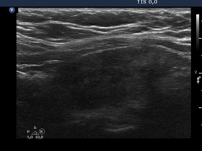 Right lobe, longitudinal scan