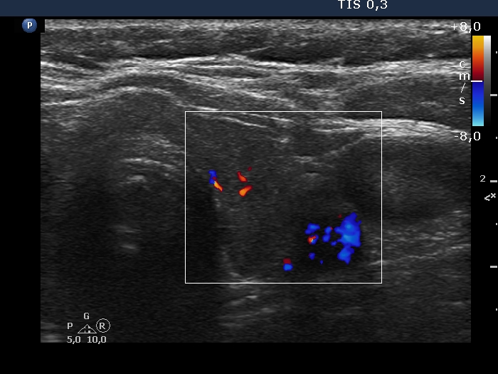 Right lobe, longitudinal scan