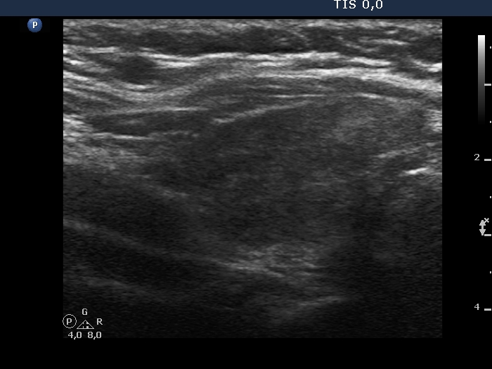 Right lobe, longitudinal scan