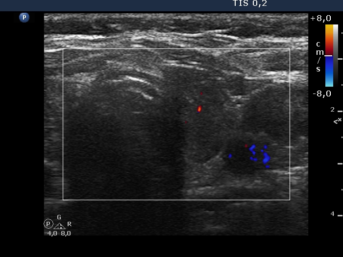 Right lobe, longitudinal scan