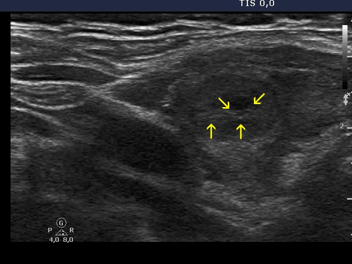 Right lobe, longitudinal scan