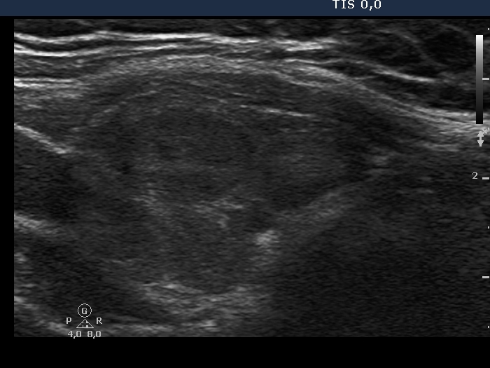 Right lobe, longitudinal scan