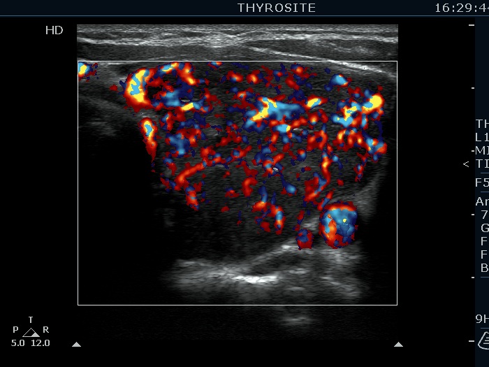 Right lobe, longitudinal scan