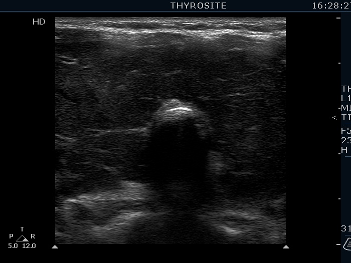 Right lobe, longitudinal scan