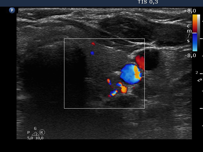 Right lobe, longitudinal scan