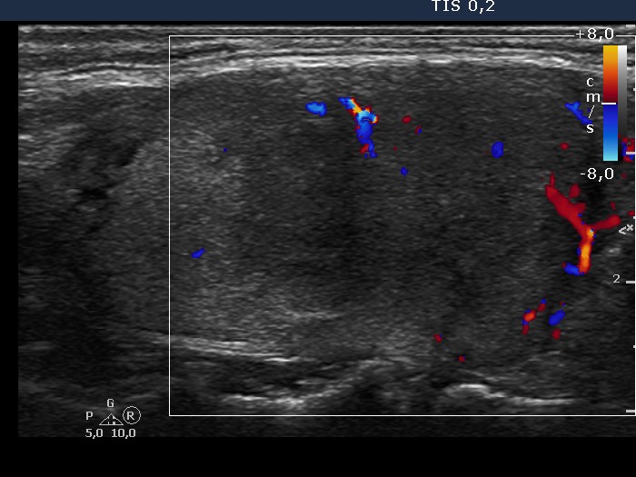 Right lobe, longitudinal scan