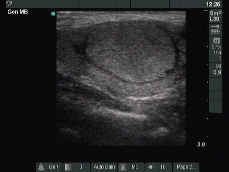 Right lobe, longitudinal scan