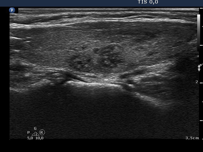 Right lobe, longitudinal scan