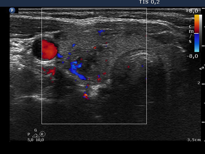 Right lobe, longitudinal scan