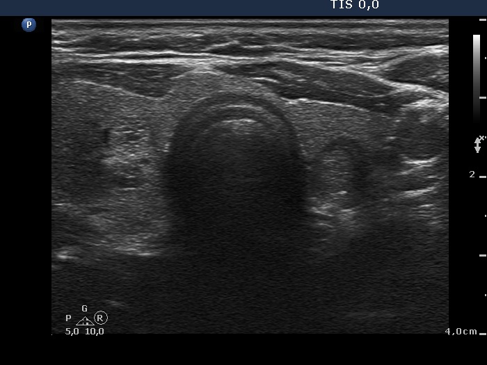 Right lobe, longitudinal scan