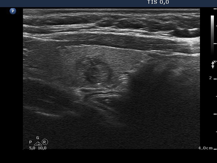 Right lobe, longitudinal scan